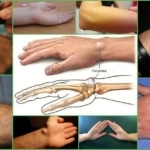 Гигрома на руке - внешние проявления патологии