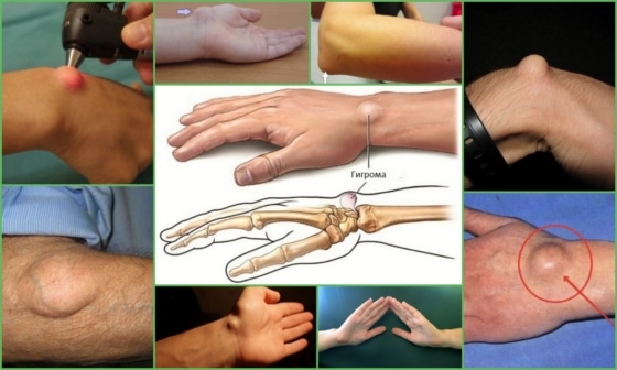 Гигрома на руке - внешние проявления патологии