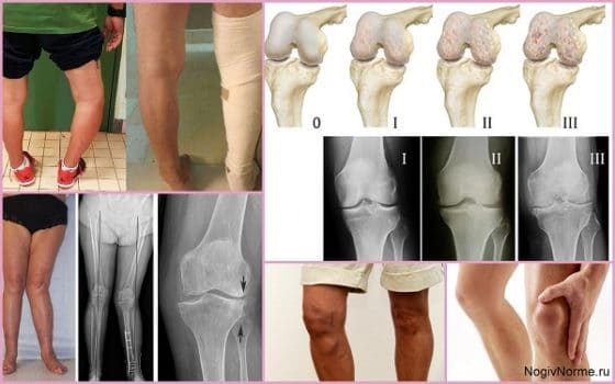 Гонартроз 3 степени коленного сустава