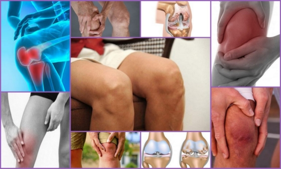 Гонартроз коленей – внешние проявления