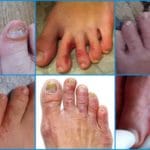 Различные виды грибка на пальцах ног