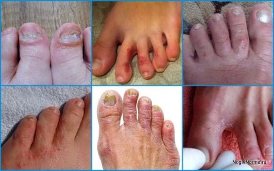 Различные виды грибка на пальцах ног