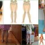 Х-образные ноги у малышей – проявления патологии