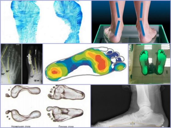 Характерные признаки плоскостопия 3 степени