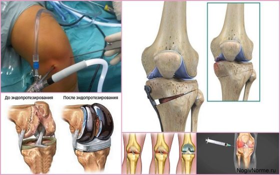 Хирургические методы лечения остеоартроза