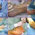 Хирургическое лечение тромбофлебита на ногах
