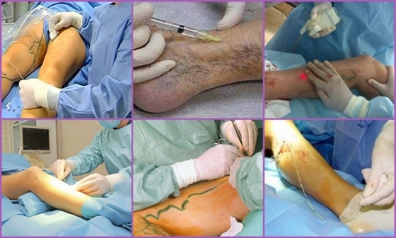 Хирургическое лечение тромбофлебита на ногах
