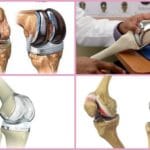 Хирургическое вмешательство при артрозе колена