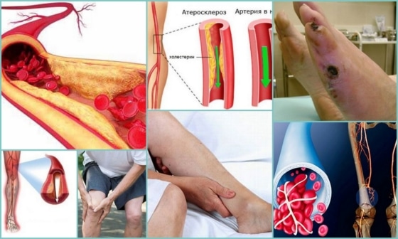 Классификации атеросклероза сосудов на ногах