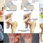 Коксартроз – цели лечения патологии