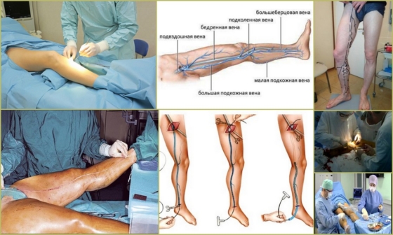 Кроссэктомия вен на ногах