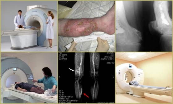 КТ при остеомиелите