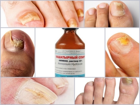 Лечение грибка на ногтях нашатырным спиртом