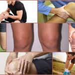 Лигаментит коленного сустава - проявления