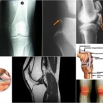 Лигаментоз колена – внешние характеристики патологии