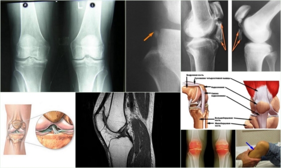 Лигаментоз колена – внешние характеристики патологии