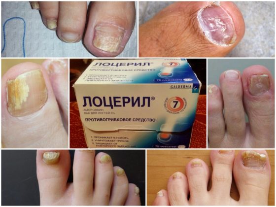 Лоцерил – эффективный препарат от грибка ногтей на ногах