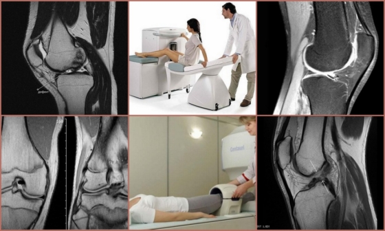 МРТ для определения патологии колена