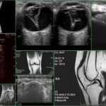 МРТ и УЗИ коленного сустава – особенности проведения