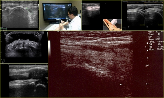 Нарушения в тканях сустава при УЗИ голеностопа