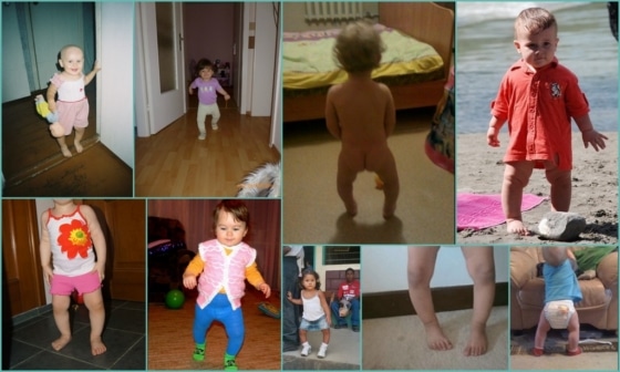 Ноги колесом у ребенка – внешние характеристики