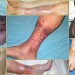 Облитерирующий атеросклероз на ногах