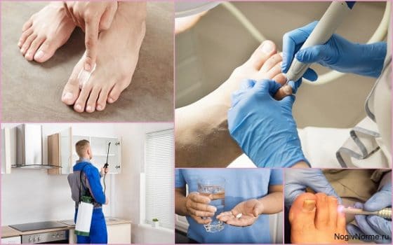 Общие принципы лечения грибка ногтей на ногах