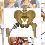Операционные методы при коксартрозе 3 степени