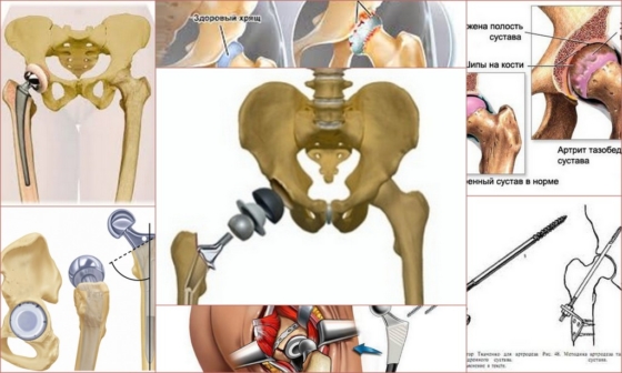 Операционные методы при коксартрозе 3 степени