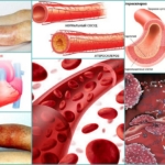 Осложнения в крупных артериях в результате прогрессирования атеросклероза