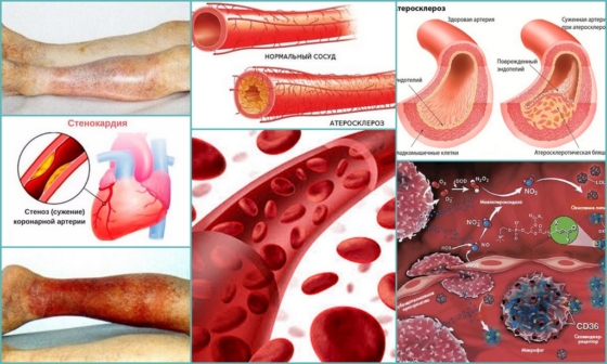 Осложнения в крупных артериях в результате прогрессирования атеросклероза