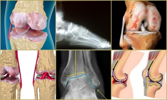 Основные стадии развития артрозо-артрита