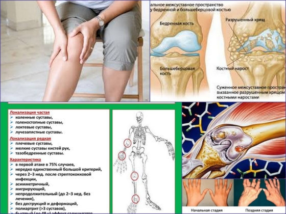 Особенности ревматического артрита