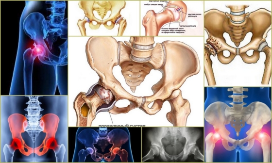 Остеоартроз тазобедренного сустава