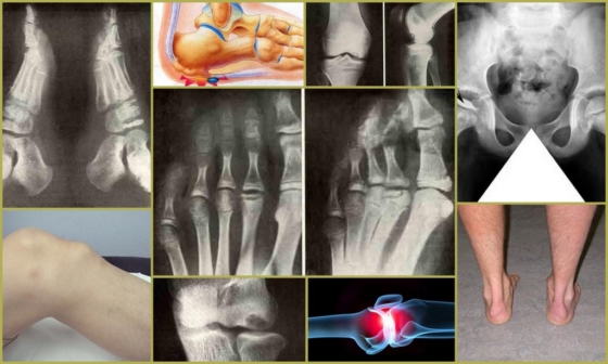 Остеохондропатия – внешние и рентгеновские проявления