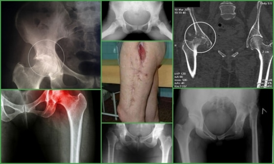 Остеомиелит тазобедренного сустава – проявления патологии