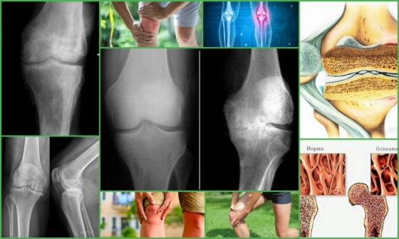Остеопороз колена – виды и стадии болезни