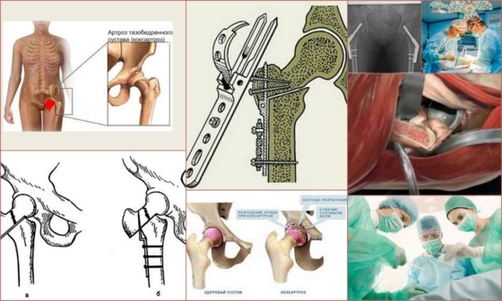 Остеотомия при коксартрозе