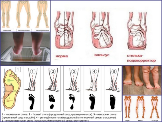 Отличие патологий вальгус, варус, плоский вальгус
