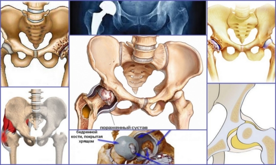 Патологии, диагностируемые на УЗИ тазобедренного сустава