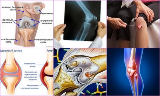 Периартрит колена – внешние характеристики