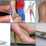 Первые симптомы тромбоза на ногах