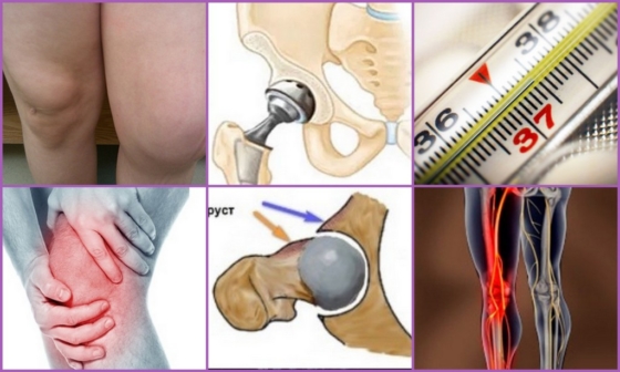 Первые симптомы возникновения осложнений эндопротезирования