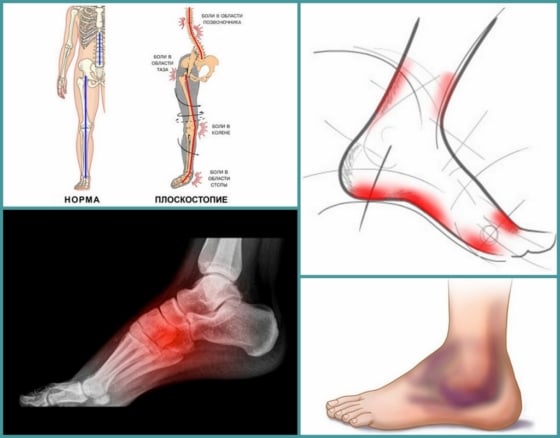 Плоскостопие и боли в разных участках организма взаимосвязаны