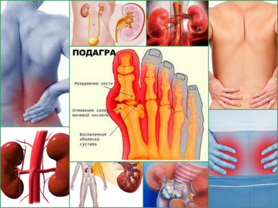 Подагрическая нефропатия - проявления