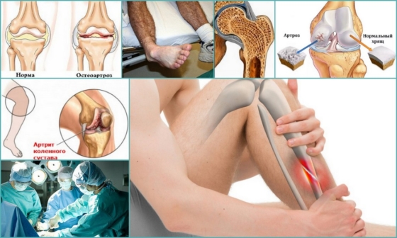Показания для проведения артродеза у пациентов