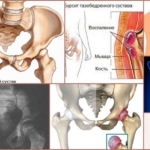 Показания для проведения блокады тазобедренного сустава
