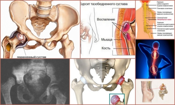 Показания для проведения блокады тазобедренного сустава