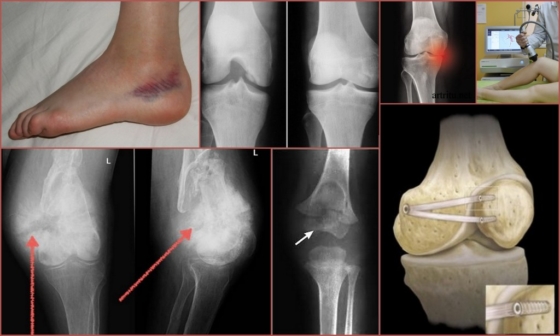 Показания для проведения рентгена колена