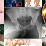 Показания для проведения рентгена тазобедренного сустава